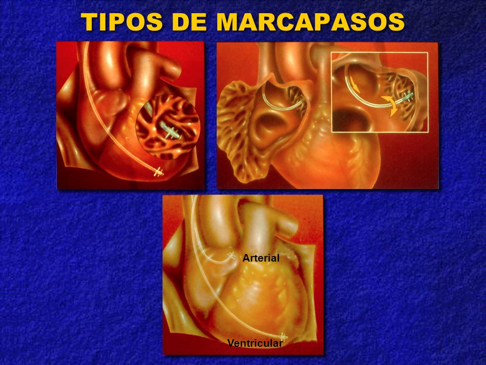TIPOS DE MARCAPASOS Arterial Ventricular