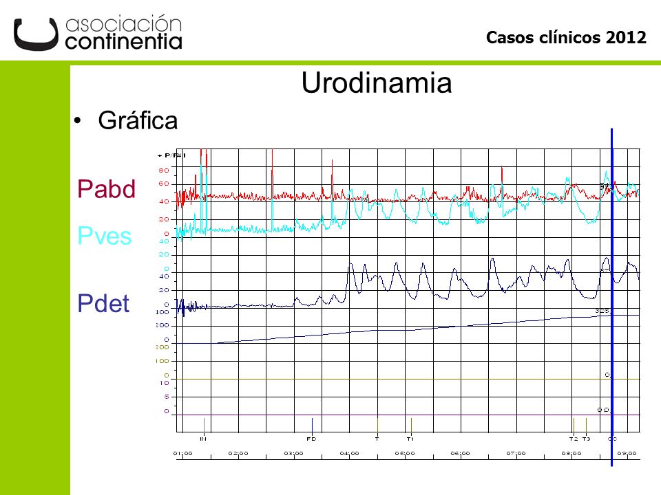 Urodinamia Gráfica Pabd Pves Pdet T y t2: paro infus