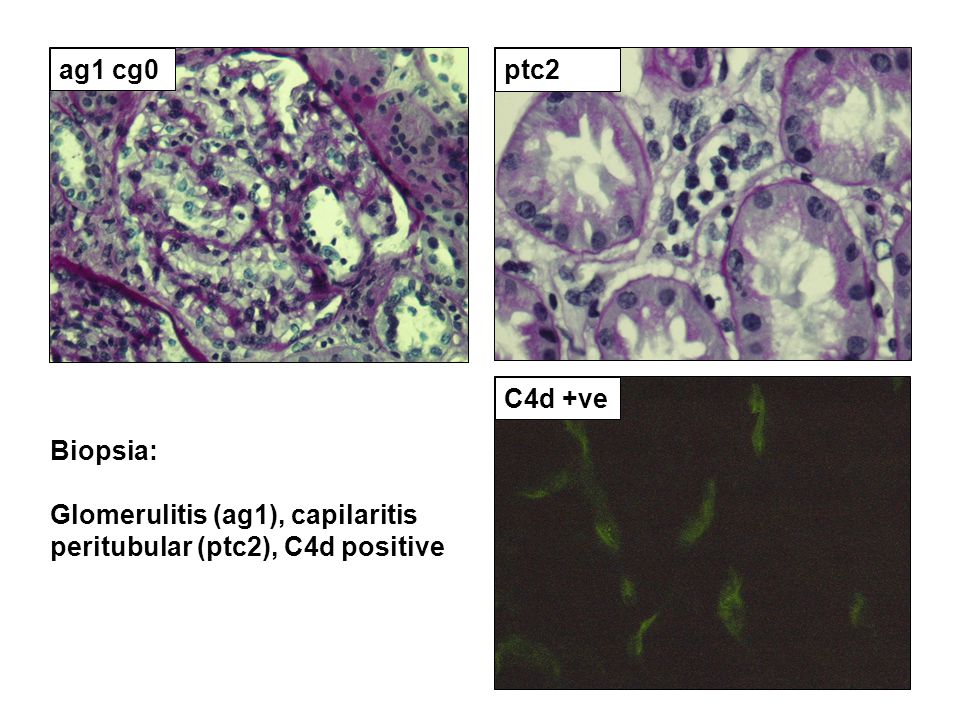 ag1 cg0 ptc2 C4d +ve Biopsia: Glomerulitis (ag1), capilaritis peritubular (ptc2), C4d positive