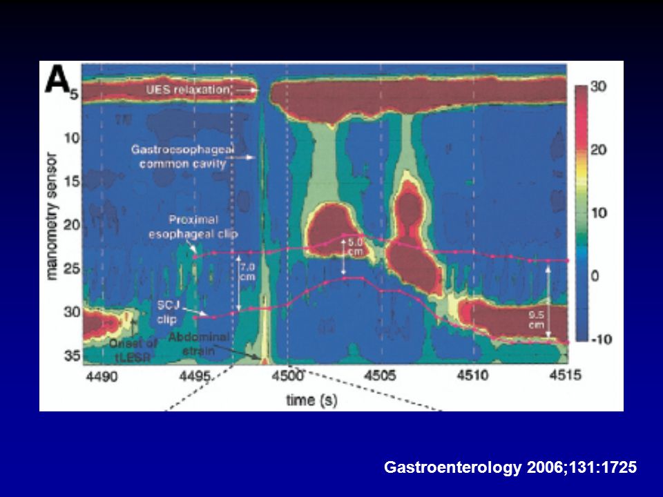 Exemplo de la formación de la cavidad común GE secundario a un esfuerzo mostrando en el análisis espectral la caracterización de la presión durante el intervalo de tiempo en que la cavidad común es generada. La relajación de la unión gastroesofágica en el inicio de la relajación transitoria del EEI con movimeinto concurrente de la unión escamocolumnar y de los clips esofágicos.(líneas magenta)