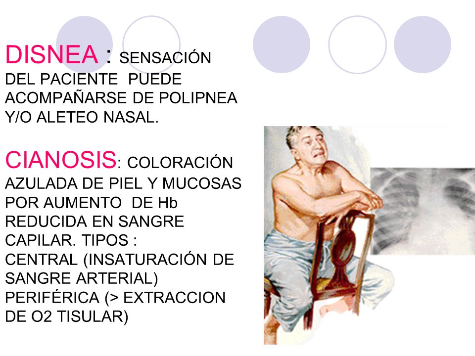 DISNEA : SENSACIÓN DEL PACIENTE PUEDE ACOMPAÑARSE DE POLIPNEA Y/O ALETEO NASAL.