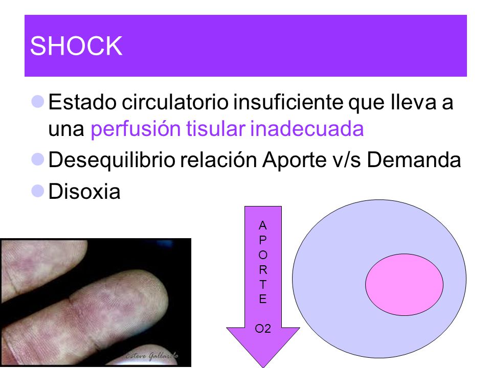 SHOCK Estado circulatorio insuficiente que lleva a una perfusión tisular inadecuada. Desequilibrio relación Aporte v/s Demanda.