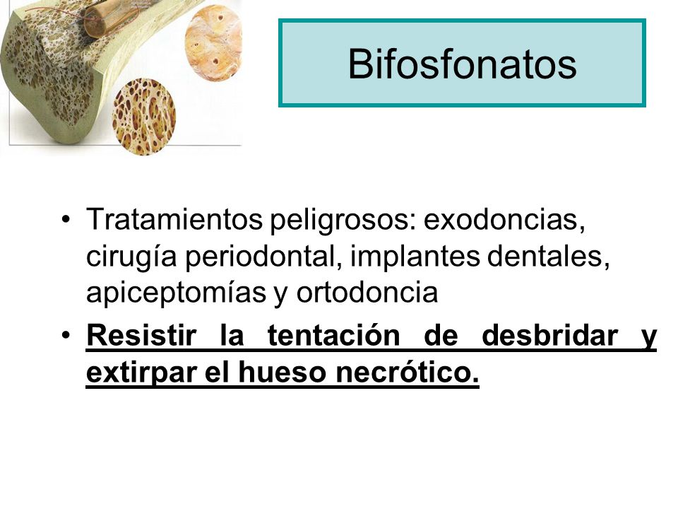 Bifosfonatos Tratamientos peligrosos: exodoncias, cirugía periodontal, implantes dentales, apiceptomías y ortodoncia.
