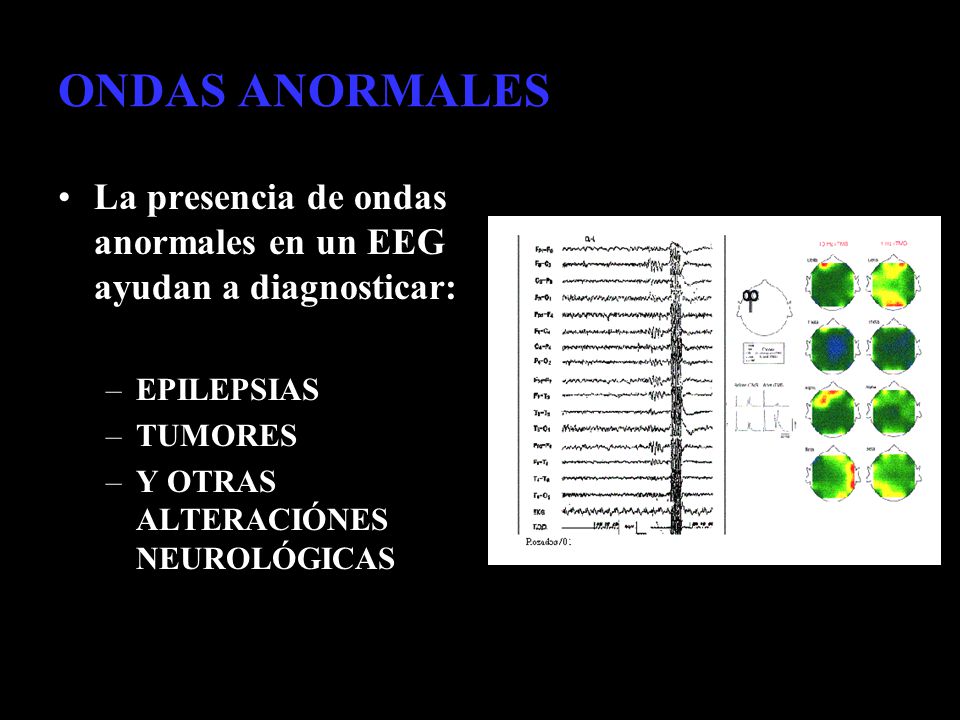 ONDAS ANORMALES La presencia de ondas anormales en un EEG ayudan a diagnosticar: EPILEPSIAS. TUMORES.