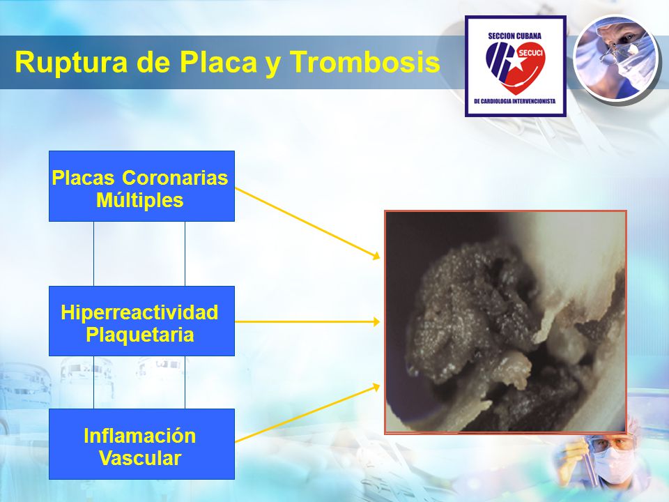 Ruptura de Placa y Trombosis Placas Coronarias Múltiples