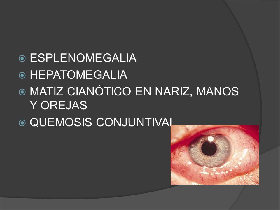 ESPLENOMEGALIA HEPATOMEGALIA MATIZ CIANÓTICO EN NARIZ, MANOS Y OREJAS QUEMOSIS CONJUNTIVAL