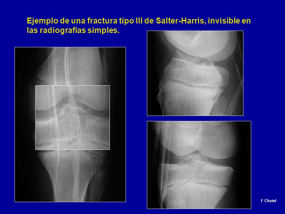 Ejemplo de una fractura tipo III de Salter-Harris, invisible en las radiografías simples.