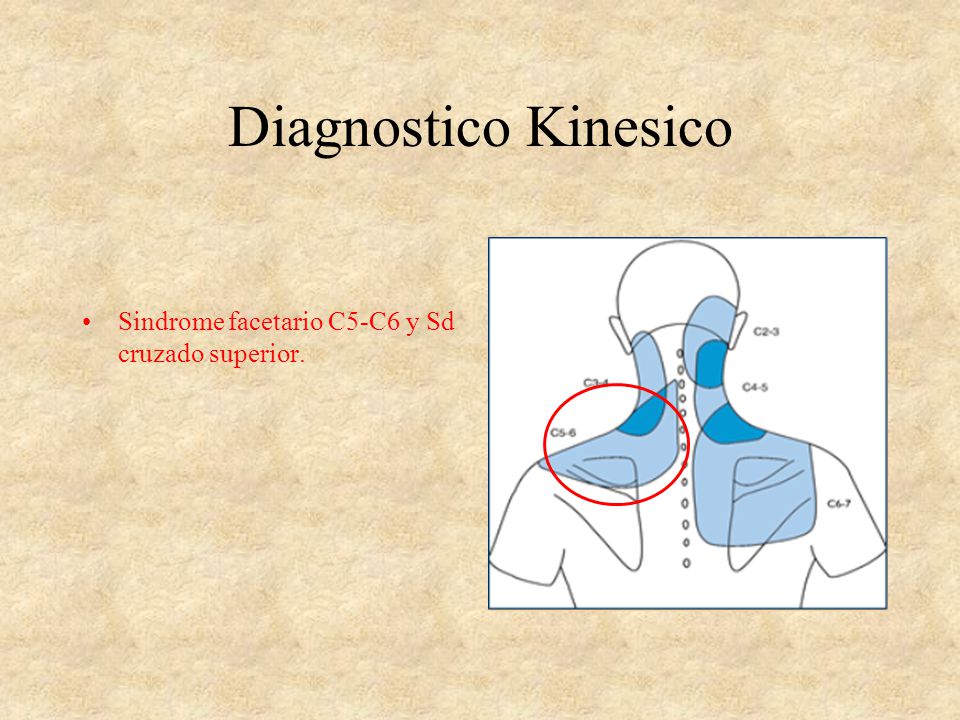 Diagnostico Kinesico Sindrome facetario C5-C6 y Sd cruzado superior.