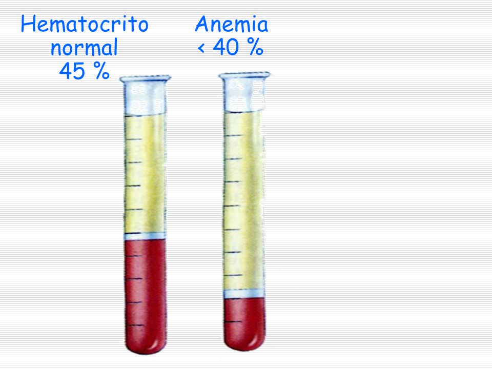Hematocrito normal 45 % Anemia < 40 %