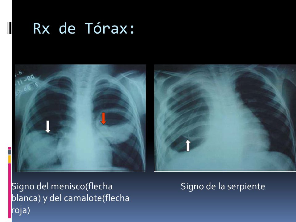 Rx de Tórax: Signo del menisco(flecha blanca) y del camalote(flecha roja) Signo de la serpiente