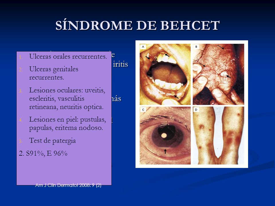 SÍNDROME DE BEHCET Episodios recurrentes de ulceras orales, genitales, iritis y lesiones cutáneas. 1:1.