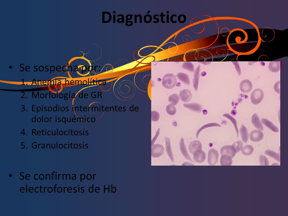 Diagnóstico Se sospecha por: Se confirma por electroforesis de Hb