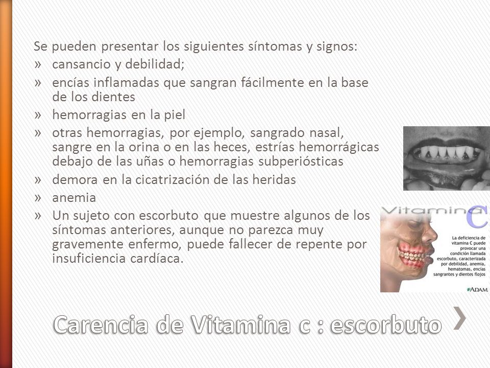 Carencia de Vitamina c : escorbuto