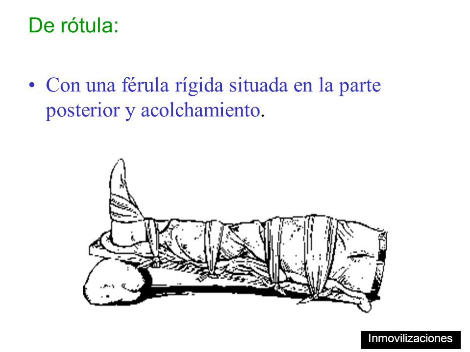 Con una férula rígida situada en la parte posterior y acolchamiento.