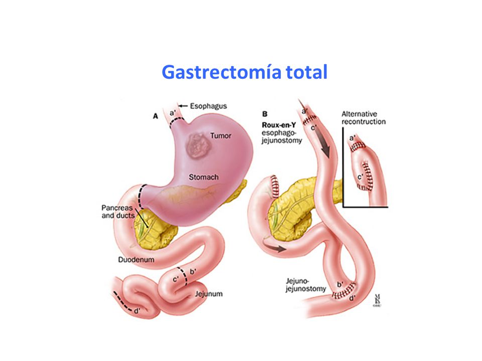 Gastrectomía total Body and midstomach tumors typically require a total resection to gain adequate margins of at least 6 cm.