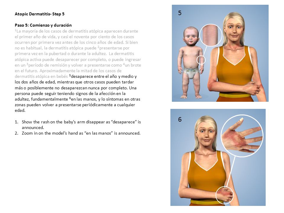 5 6 Atopic Dermatitis- Step 5 Paso 5: Comienzo y duración