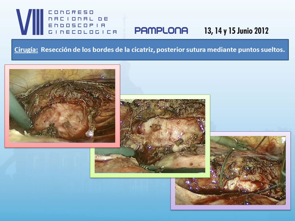 Cirugía: Resección de los bordes de la cicatriz, posterior sutura mediante puntos sueltos.
