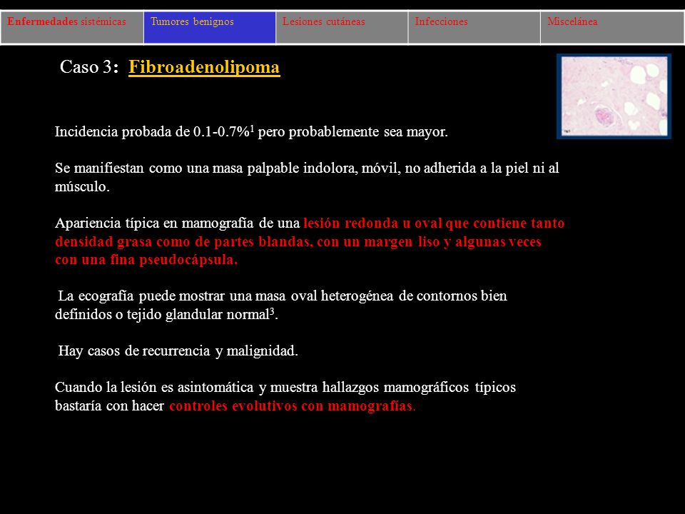 Caso 3: Fibroadenolipoma