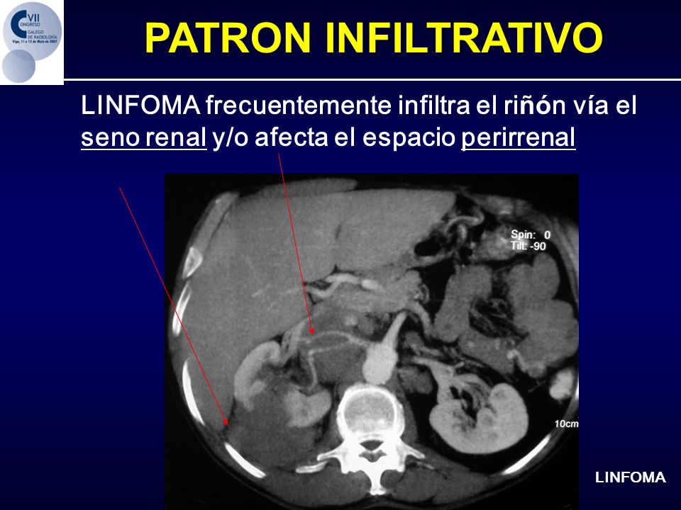 PATRON INFILTRATIVO LINFOMA frecuentemente infiltra el riñón vía el seno renal y/o afecta el espacio perirrenal.