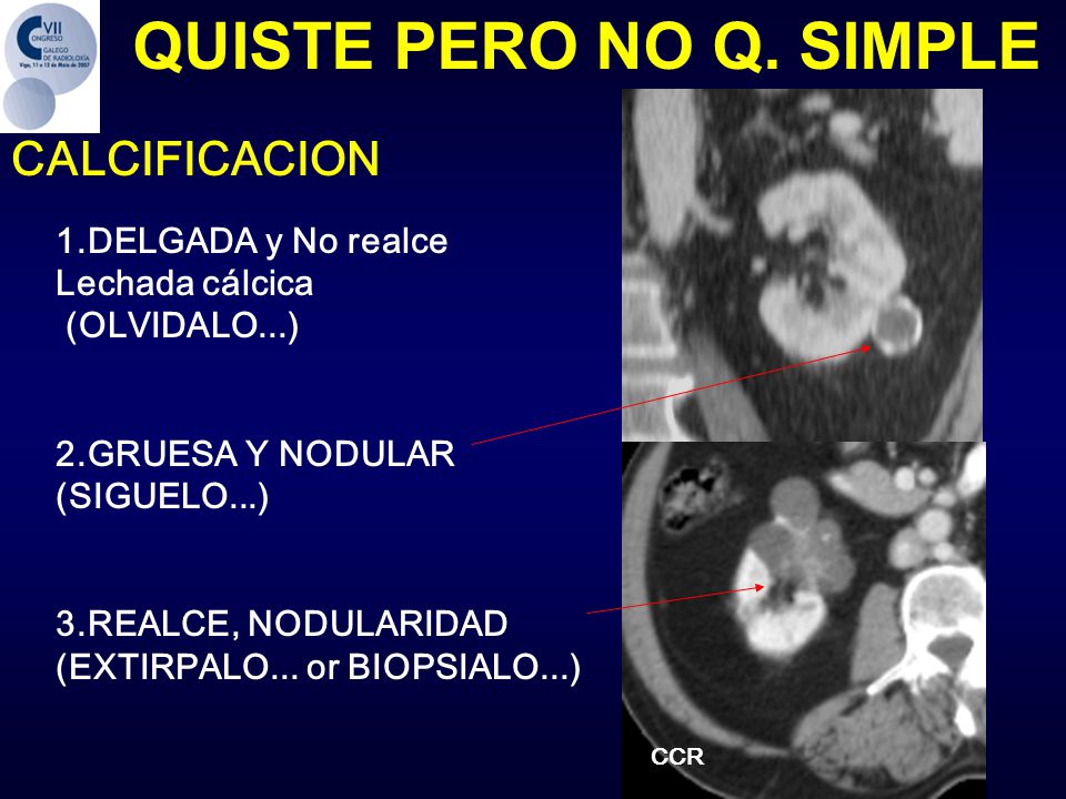 QUISTE PERO NO Q. SIMPLE CALCIFICACION 1.DELGADA y No realce