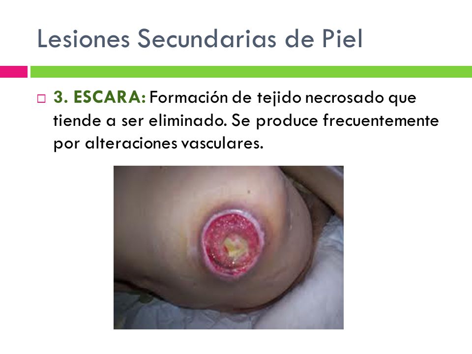 Lesiones Secundarias de Piel