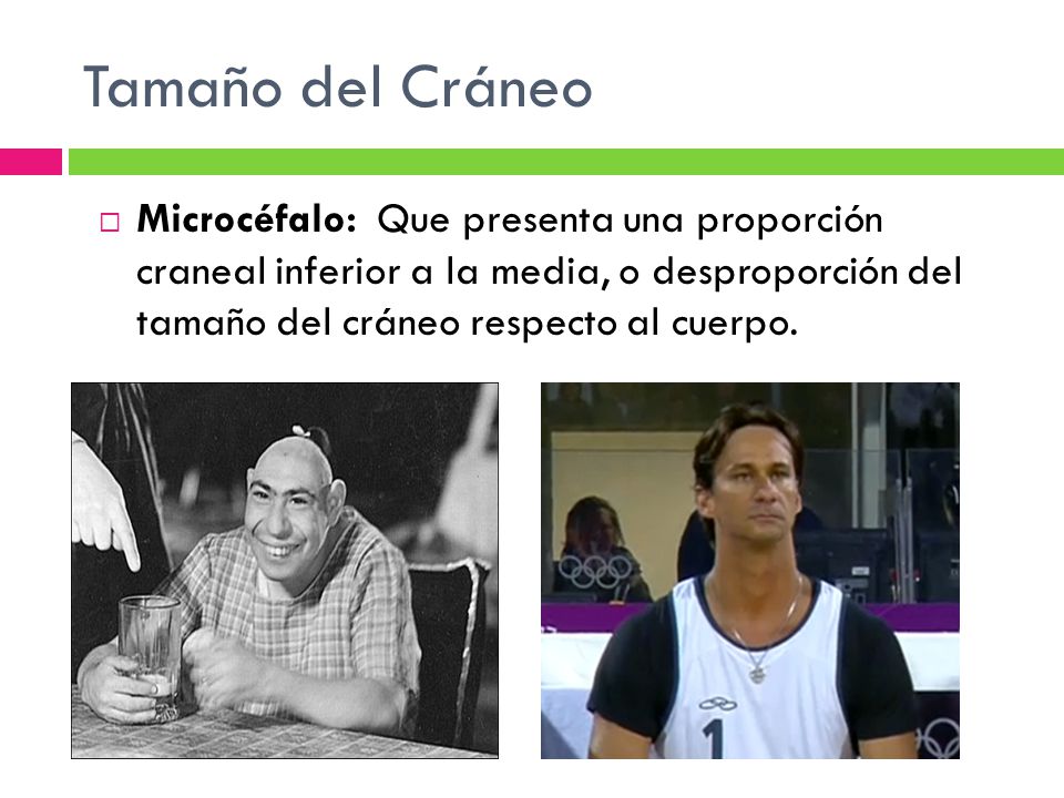 Tamaño del Cráneo Microcéfalo: Que presenta una proporción craneal inferior a la media, o desproporción del tamaño del cráneo respecto al cuerpo.