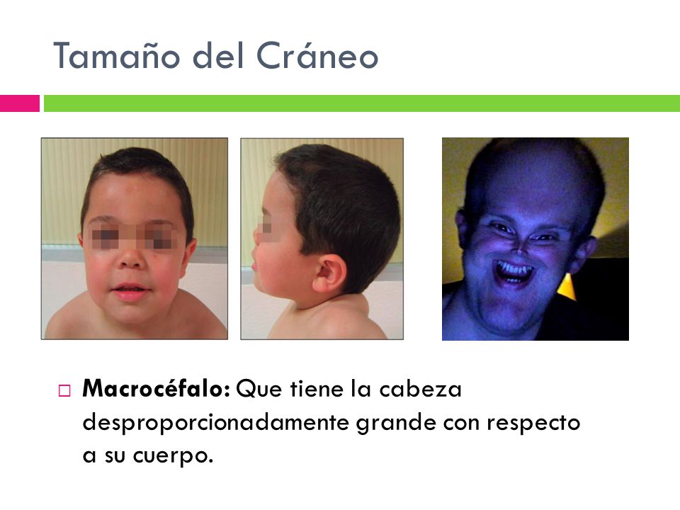 Tamaño del Cráneo Macrocéfalo: Que tiene la cabeza desproporcionadamente grande con respecto a su cuerpo.