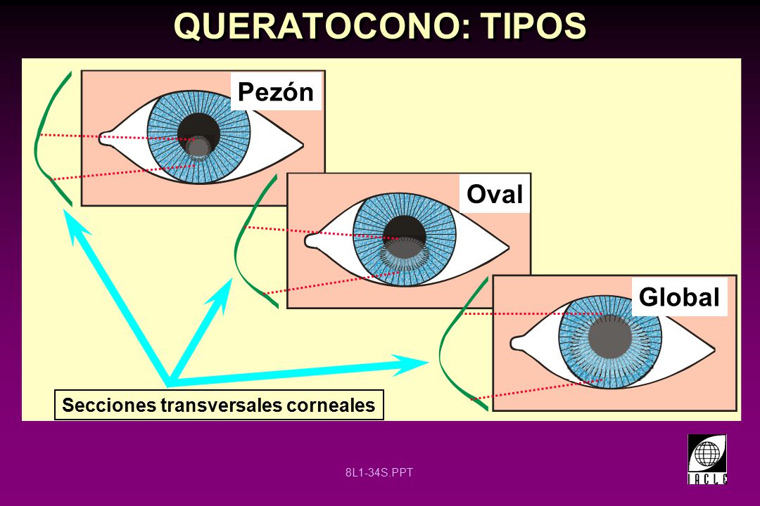 QUERATOCONO: TIPOS Pezón Oval Global Secciones transversales corneales