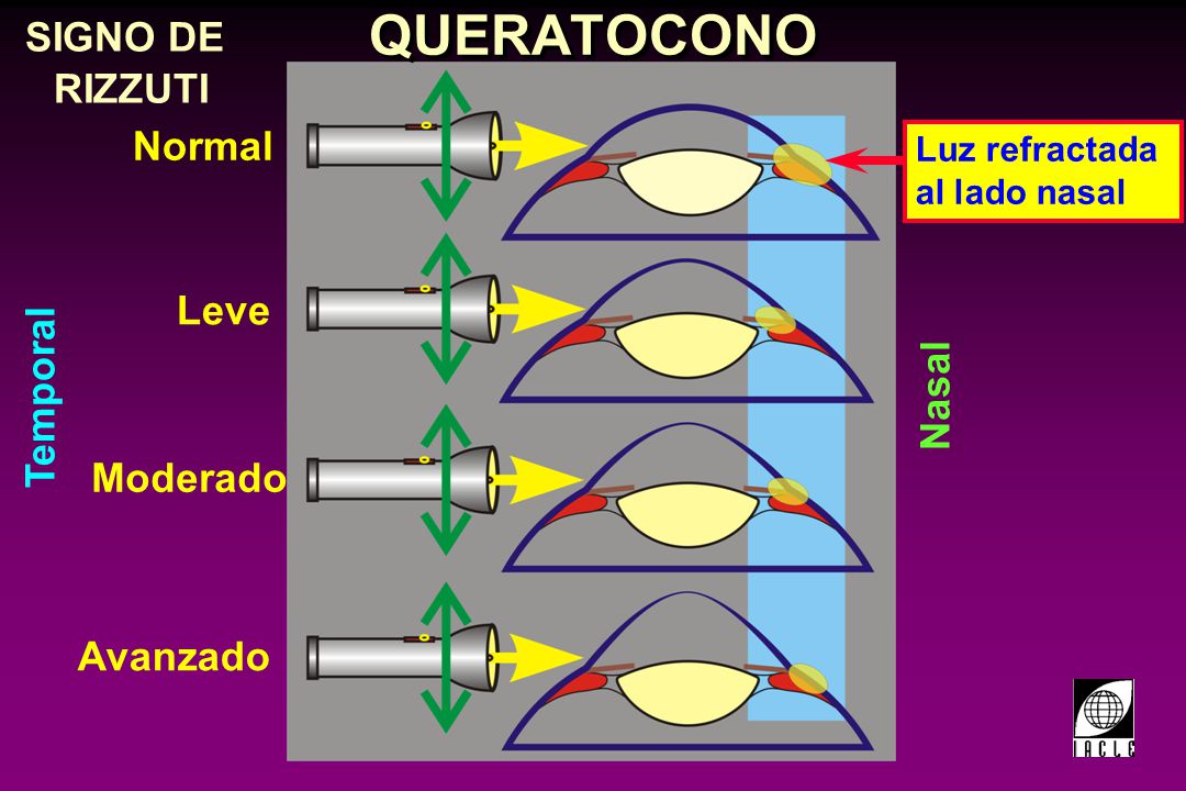 QUERATOCONO SIGNO DE RIZZUTI Normal Leve Temporal Nasal Moderado