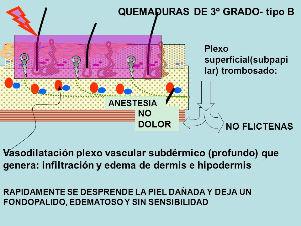 QUEMADURAS DE 3º GRADO- tipo B