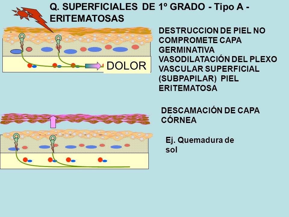 DOLOR Q. SUPERFICIALES DE 1º GRADO - Tipo A - ERITEMATOSAS