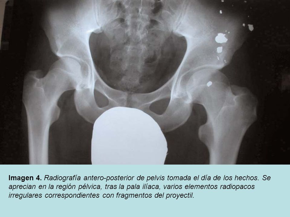 Imagen 4. Radiografía antero-posterior de pelvis tomada el día de los hechos.