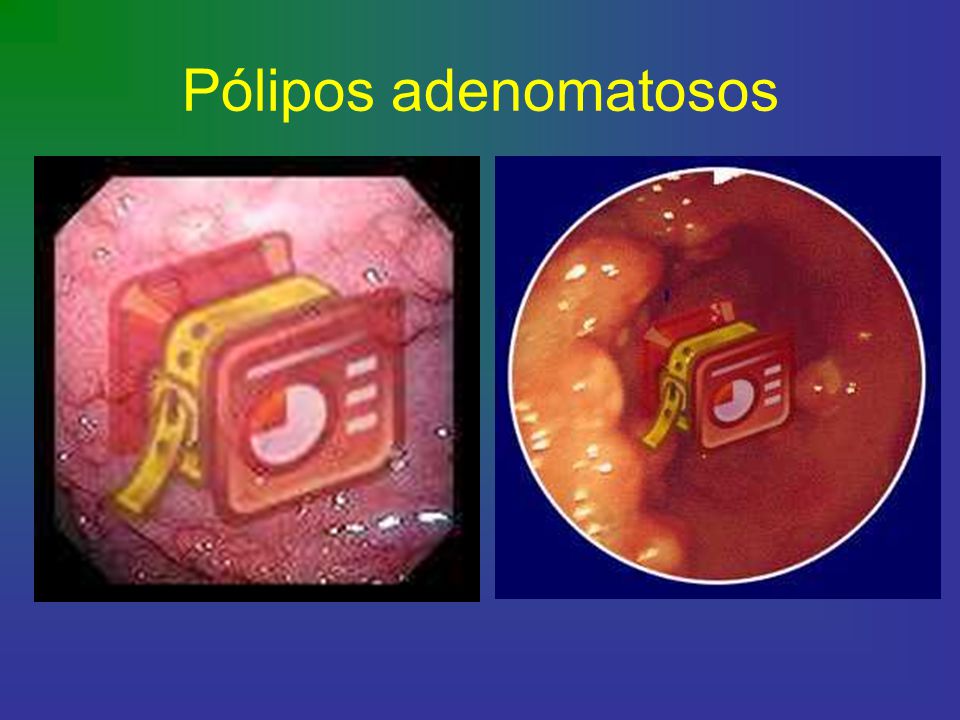 Pólipos adenomatosos