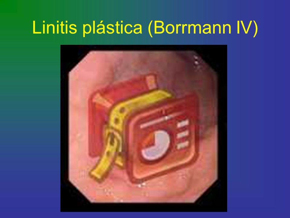 Linitis plástica (Borrmann IV)