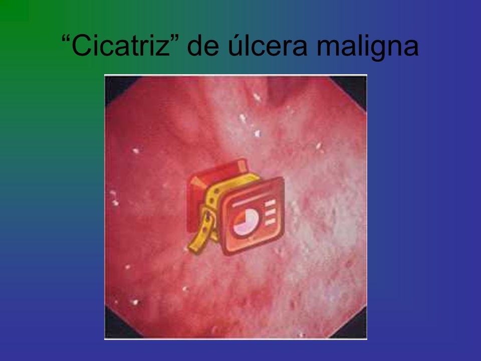 Cicatriz de úlcera maligna