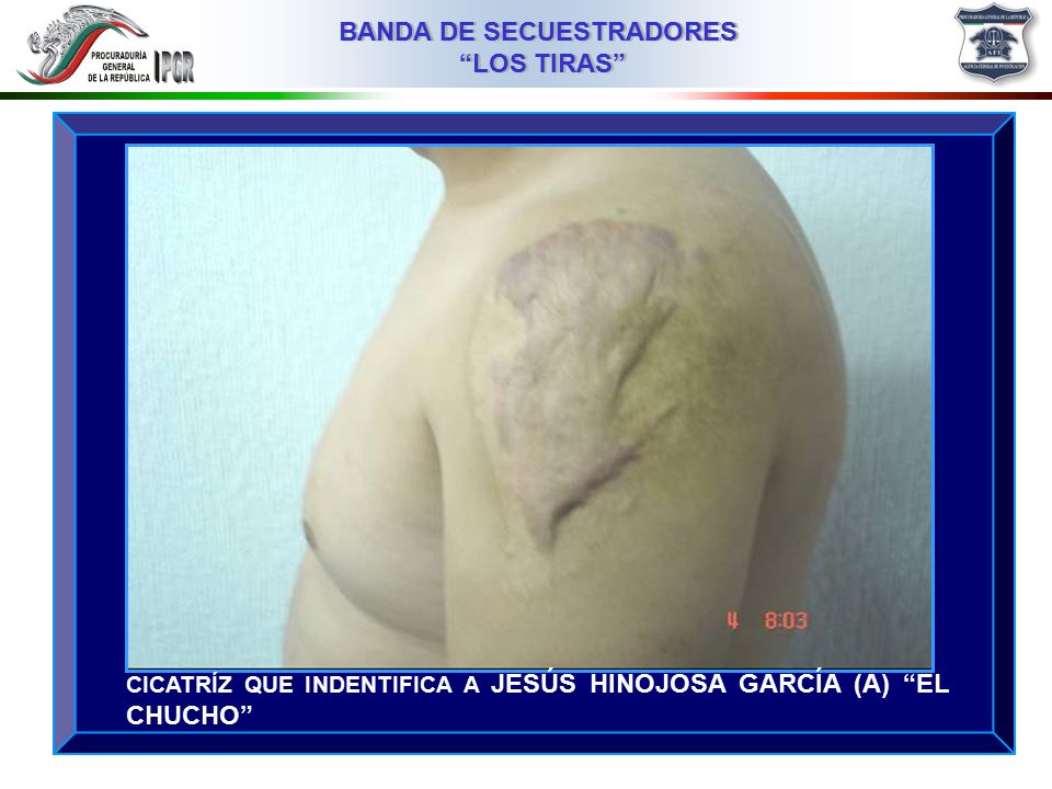 CICATRÍZ QUE INDENTIFICA A JESÚS HINOJOSA GARCÍA (A) EL CHUCHO
