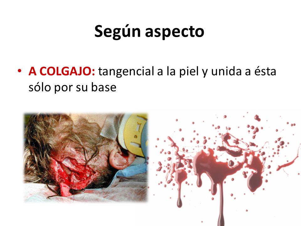 Según aspecto A COLGAJO: tangencial a la piel y unida a ésta sólo por su base