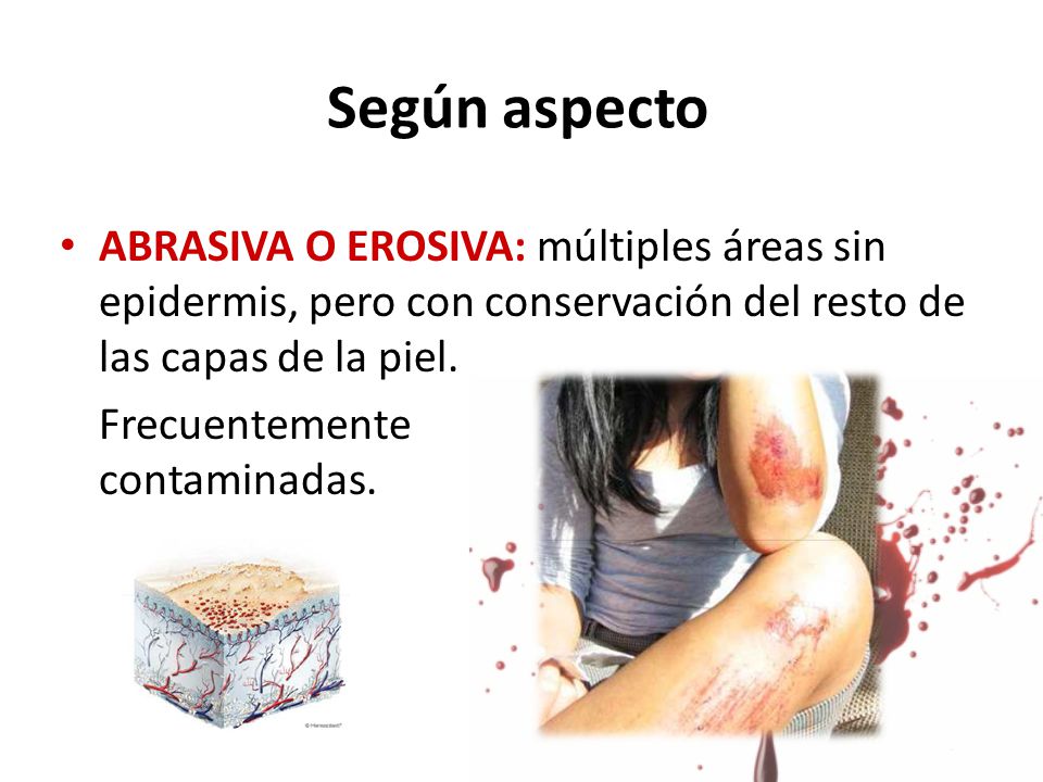 Según aspecto ABRASIVA O EROSIVA: múltiples áreas sin epidermis, pero con conservación del resto de las capas de la piel.