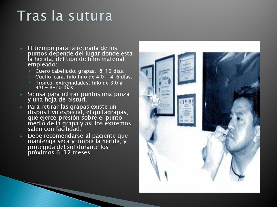 Tras la sutura El tiempo para la retirada de los puntos depende del lugar donde esta la herida, del tipo de hilo/material empleado: