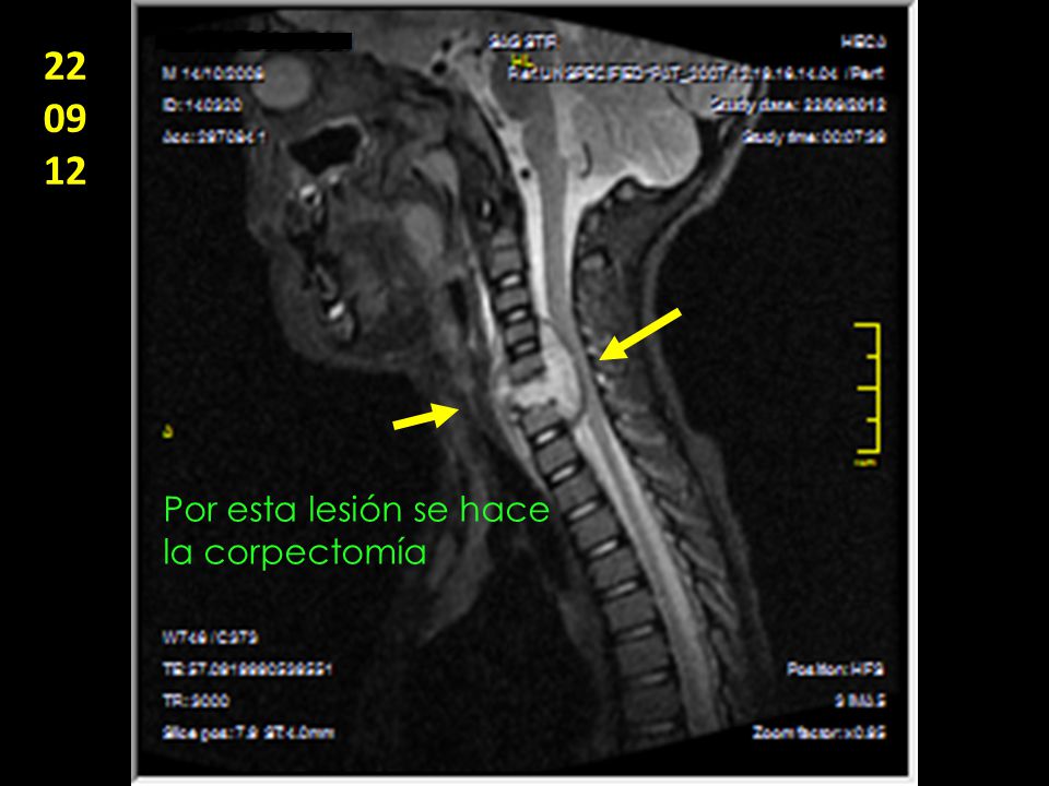 Por esta lesión se hace la corpectomía