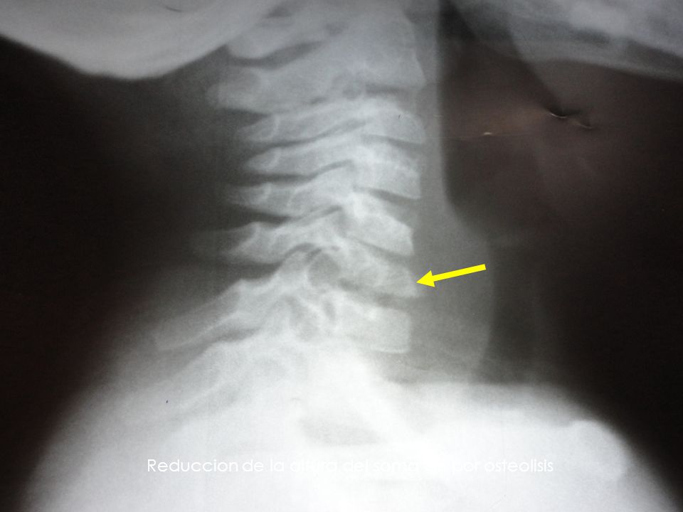 Reduccion de la altura del soma C6 por osteolisis