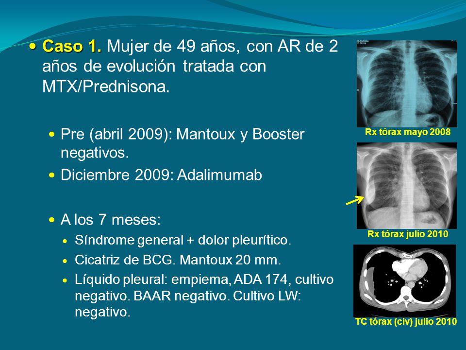 Caso 1. Mujer de 49 años, con AR de 2 años de evolución tratada con MTX/Prednisona.