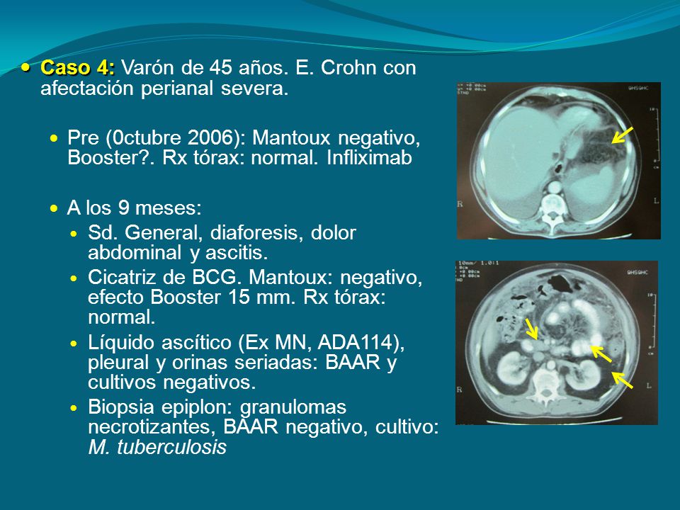 Caso 4: Varón de 45 años. E. Crohn con afectación perianal severa.