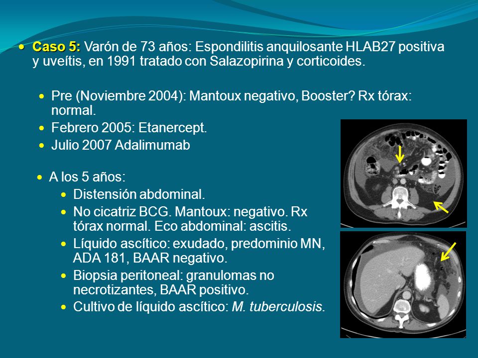 Pre (Noviembre 2004): Mantoux negativo, Booster Rx tórax: normal.