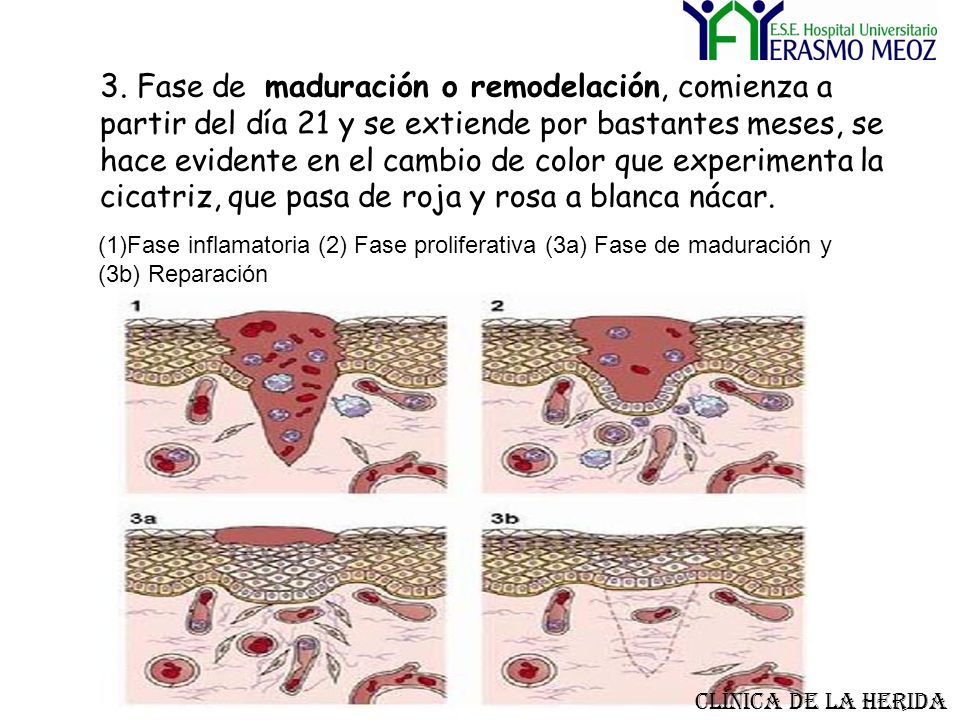 3. Fase de maduración o remodelación, comienza a partir del día 21 y se extiende por bastantes meses, se hace evidente en el cambio de color que experimenta la cicatriz, que pasa de roja y rosa a blanca nácar.