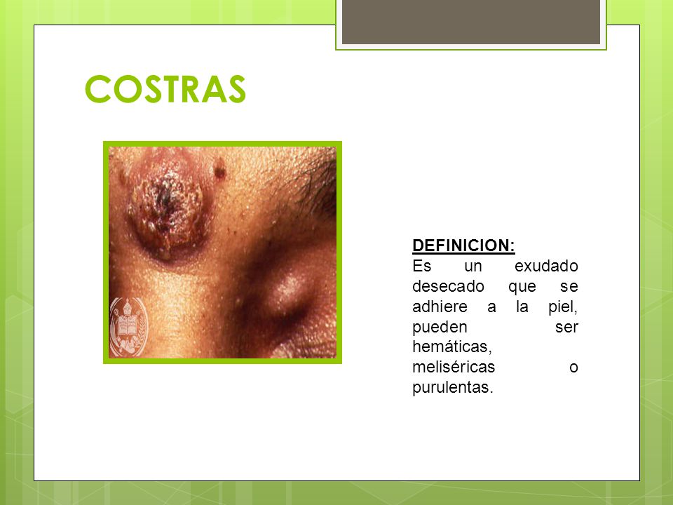 COSTRAS DEFINICION: Es un exudado desecado que se adhiere a la piel, pueden ser hemáticas, meliséricas o purulentas.