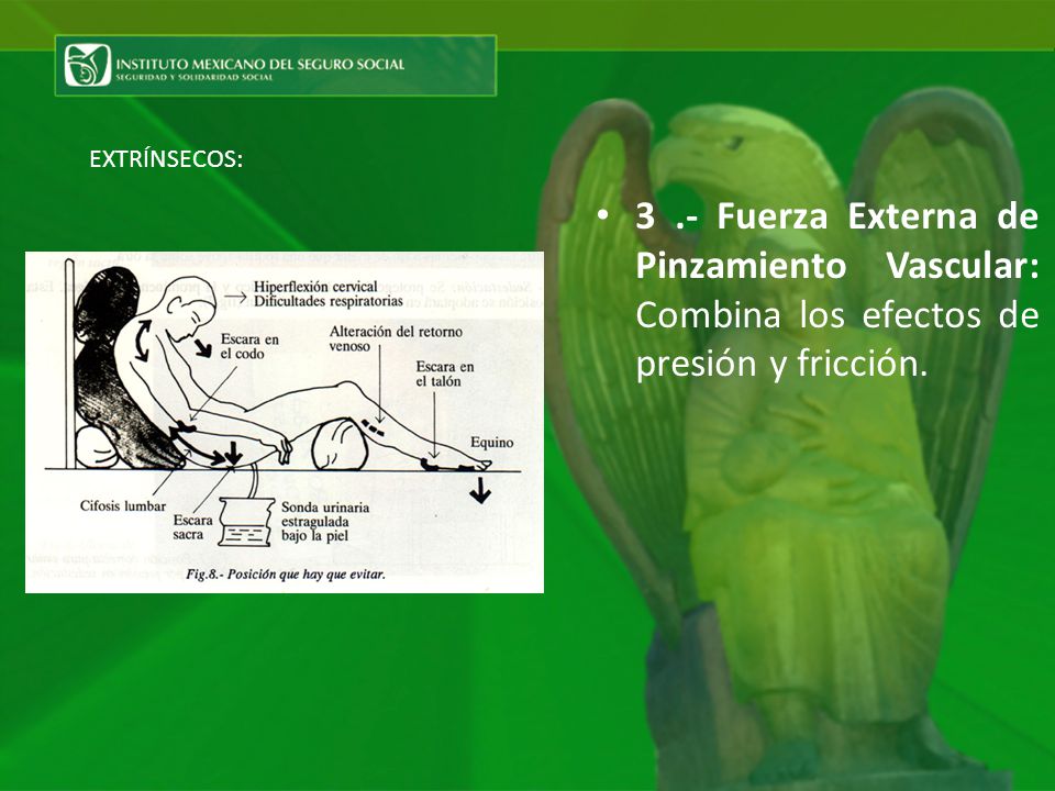EXTRÍNSECOS: 3 .- Fuerza Externa de Pinzamiento Vascular: Combina los efectos de presión y fricción.