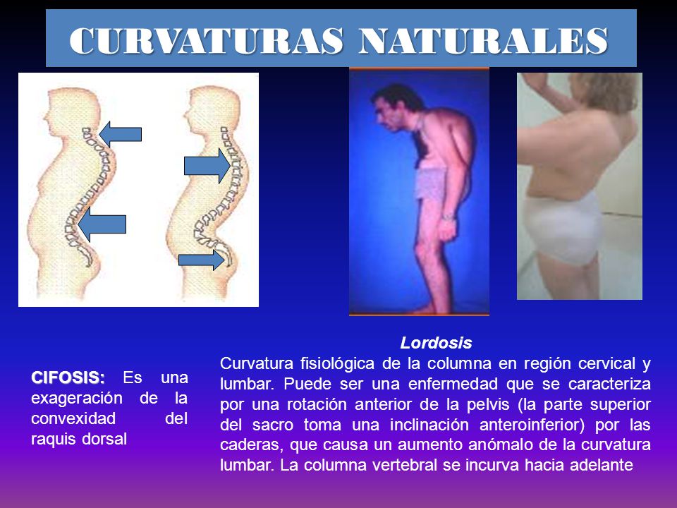 CURVATURAS NATURALES Lordosis