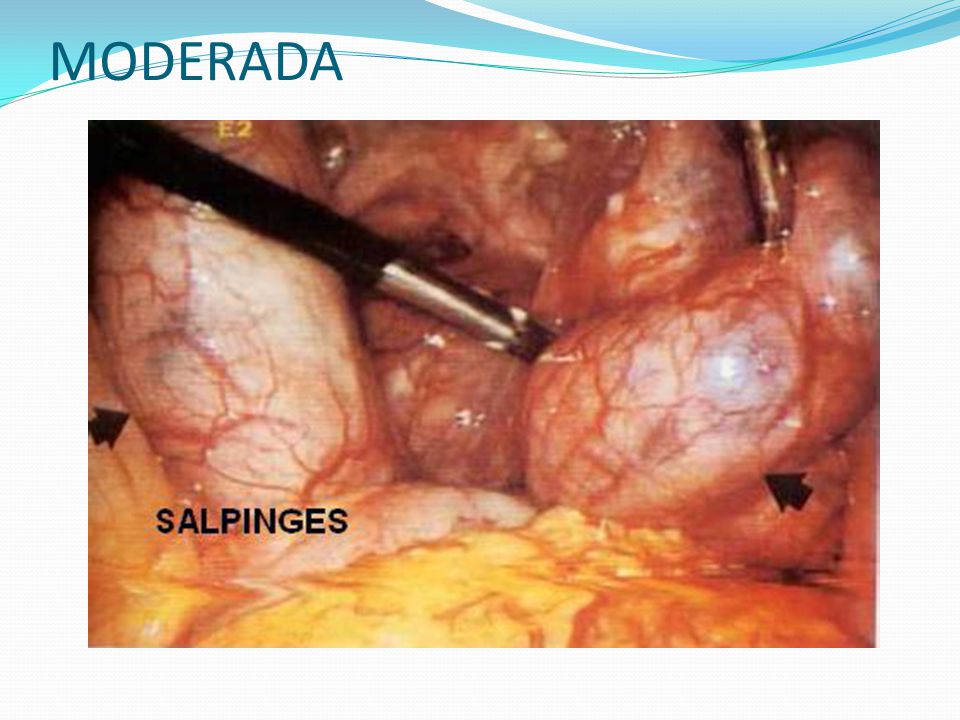 MODERADA