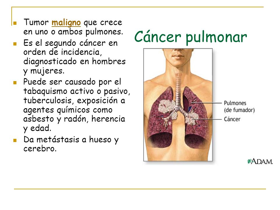 Cáncer pulmonar Tumor maligno que crece en uno o ambos pulmones.